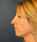 Feel Beautiful - Rhinoplasty 226 - Before Photo